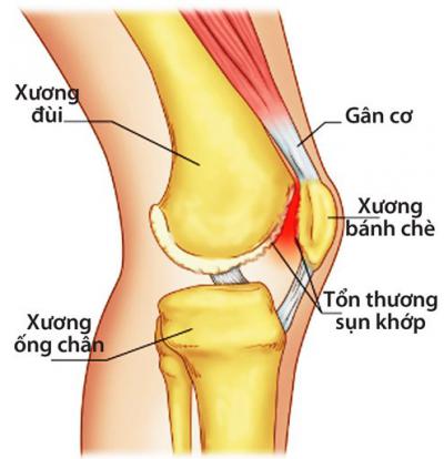 Bênh về xương khớp ngày càng trẻ hóa 